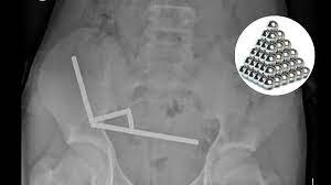 13-year-old boy hospitalized and loses part of bowel after swallowing dozens of high-powered magnets